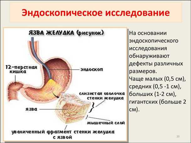 Протонно-насосные ингибиторы