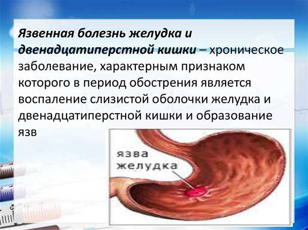 Как узнать о наличии язвы желудка?