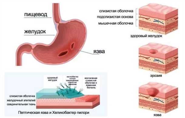 Язва желудка: симптомы и лечение (диета, препараты, хирургия, народное)