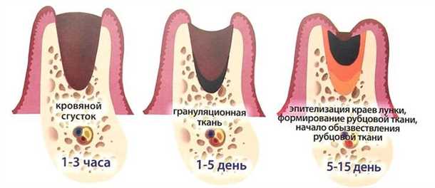Последствия удаления зуба