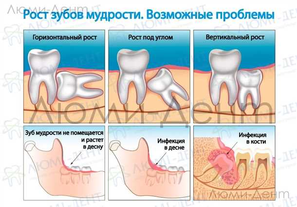 Определение зуба мудрости и связанные проблемы