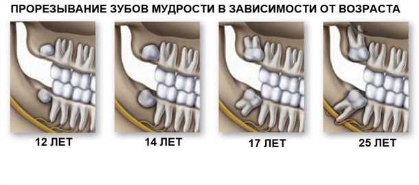 2. Болезненный прорыв зуба